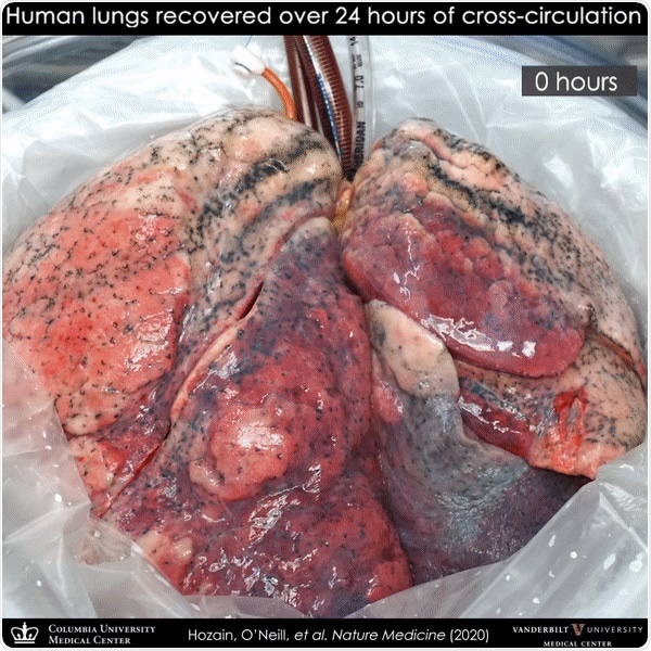 Video showing the sequence of lung recovery in a cross circulation system.