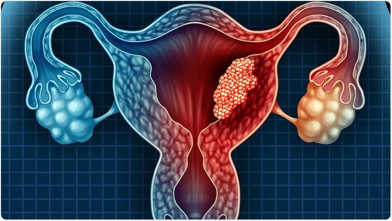 Newly discovered endometrial cancer biomarker enables early detection and treatment