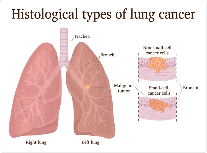 non-small-cell-lung-cancer-cancer-therapy-advisor