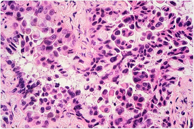 what-are-the-differences-between-small-cell-and-non-small-cell-lung-cancer