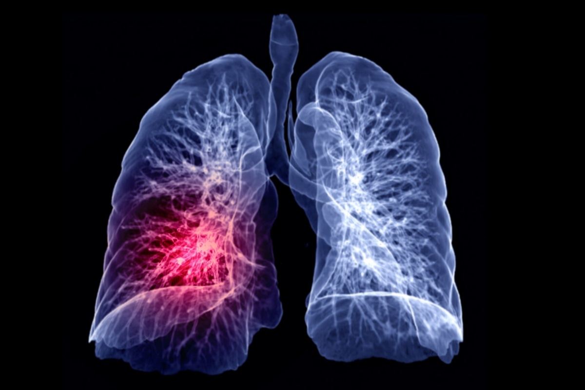 covid 19 et cancer de poumon ont une voie classique disent des chercheurs