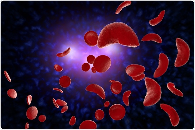 Sickle Cell Disease Treatment