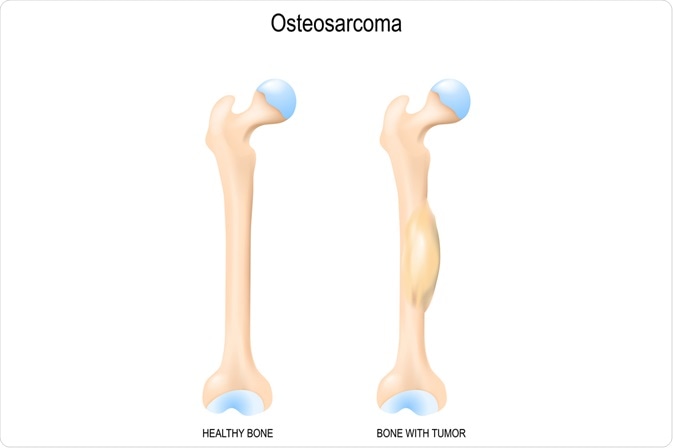 Osteosarcoma