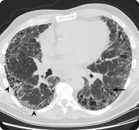 IPF diagnosis: how do patients feel about the discussion with their ...