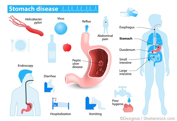 Causes of Bleeding in the Upper and Lower Gastrointestinal Tract