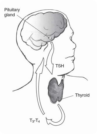 Hypothyroidism - 