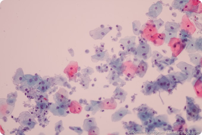 Trichomoniasis Diagnosis